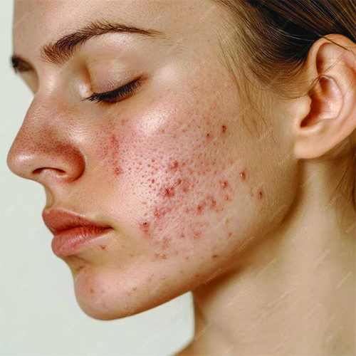 ROUTINE DA THÂM MỤN, TĂNG SÁC TỐ SAU VIÊM
